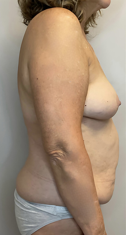 Before Image: Mommy Makeover - right-side