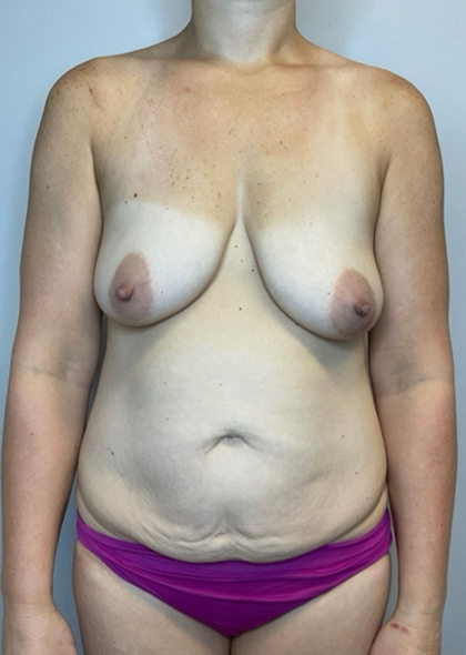 Before Image: Mommy Makeover - front