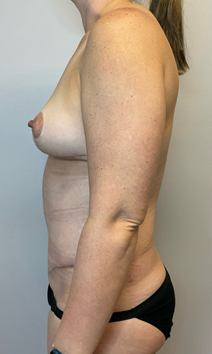 After Image: Mommy Makeover - left-side