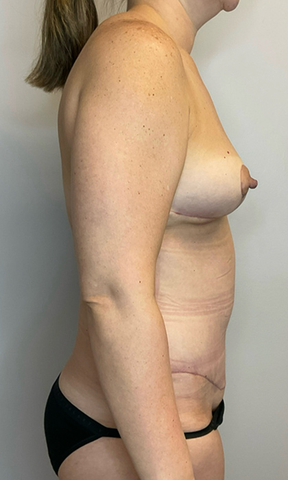 After Image: Mommy Makeover - right-side