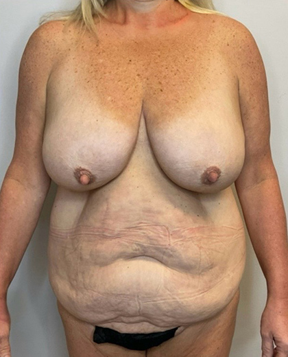 Before Image: Mommy Makeover - front