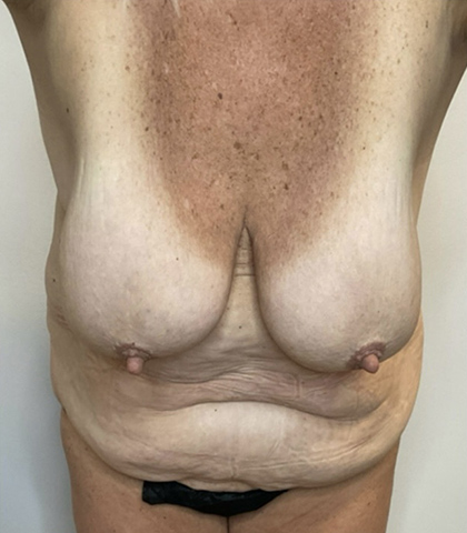 Before Image: Mommy Makeover - front