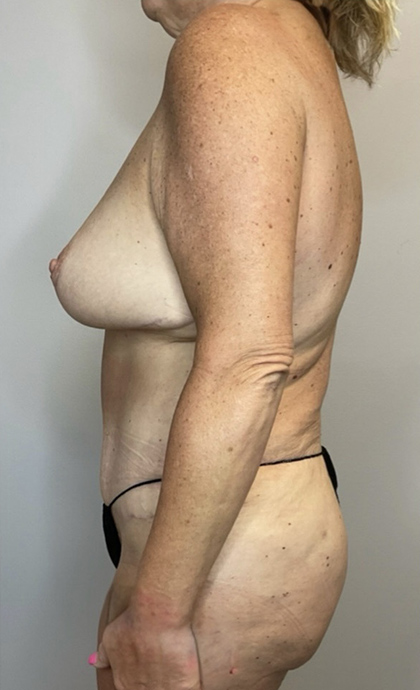 After Image: Mommy Makeover - left-side