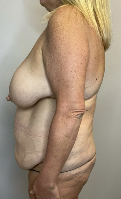 Before Image: Mommy Makeover - left-side