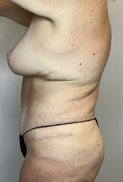 After Image: Mommy Makeover - left-side