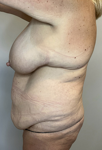 Before Image: Mommy Makeover - left-side