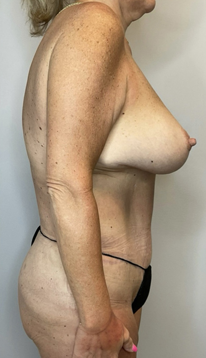 After Image: Mommy Makeover - right-side