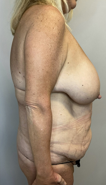 Before Image: Mommy Makeover - right-side