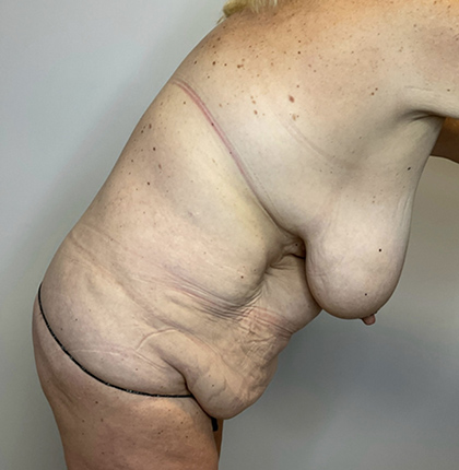 Before Image: Mommy Makeover - right-side