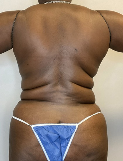 After Image: Liposuction, Tummy Tuck - back