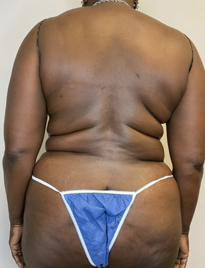 After Image: Liposuction, Tummy Tuck - back