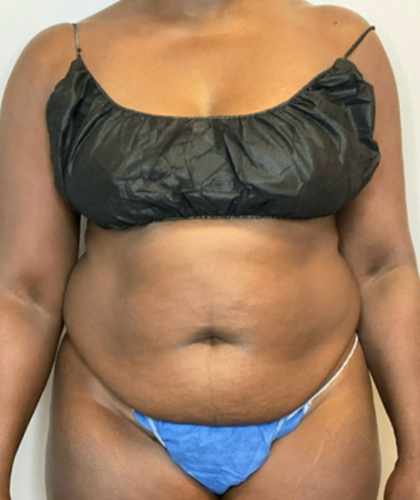 Before Image: Liposuction, Tummy Tuck - front