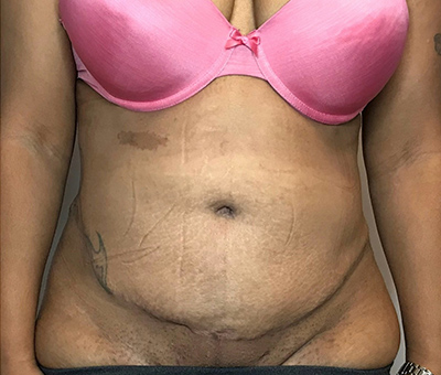 After Image: Liposuction, Tummy Tuck - front