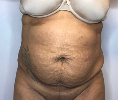 Before Image: Liposuction, Tummy Tuck - front