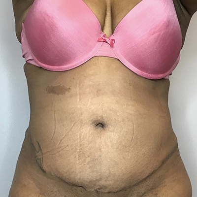 After Image: Liposuction, Tummy Tuck - front