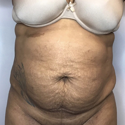 Before Image: Liposuction, Tummy Tuck - front