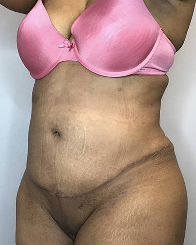 After Image: Liposuction, Tummy Tuck - left-front-oblique