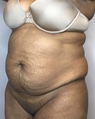 Before Image: Liposuction, Tummy Tuck - left-front-oblique