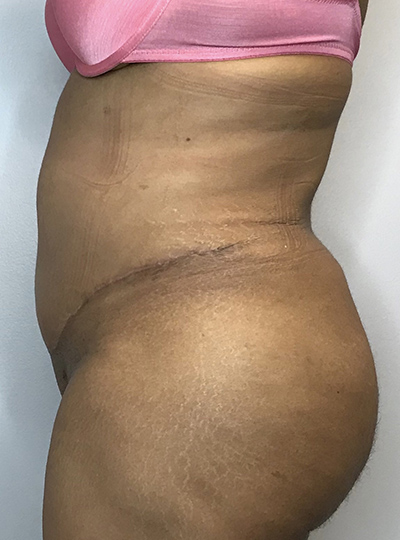 After Image: Liposuction, Tummy Tuck - left-side