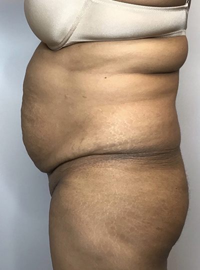 Before Image: Liposuction, Tummy Tuck - left-side