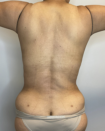 After Image: Liposuction, Tummy Tuck - back