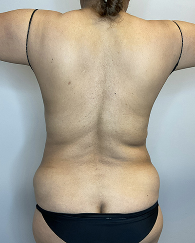 Before Image: Liposuction, Tummy Tuck - back