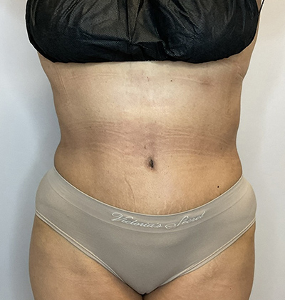 After Image: Liposuction, Tummy Tuck - front