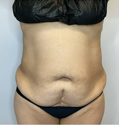Before Image: Liposuction, Tummy Tuck - front