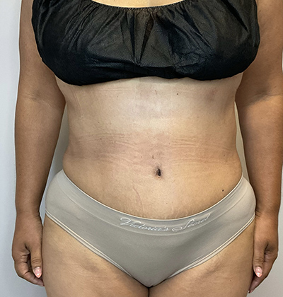 After Image: Liposuction, Tummy Tuck - front