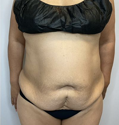 Before Image: Liposuction, Tummy Tuck - front