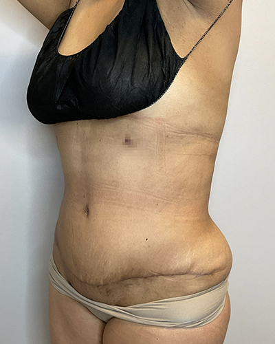 After Image: Liposuction, Tummy Tuck - left-front-oblique