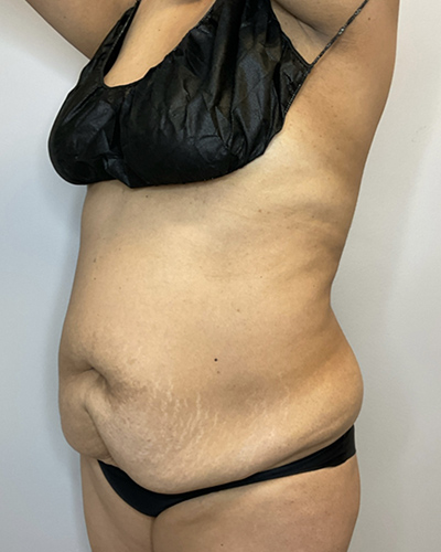 Before Image: Liposuction, Tummy Tuck - left-front-oblique