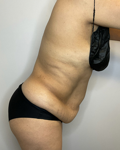 Before Image: Liposuction, Tummy Tuck - right-side