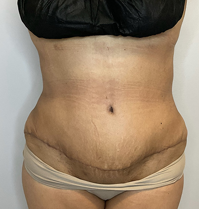 After Image: Tummy Tuck - front