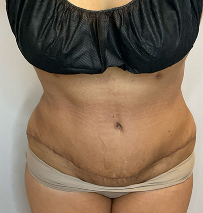 After Image: Tummy Tuck - front