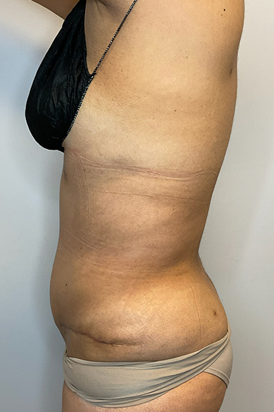 After Image: Tummy Tuck - left-side