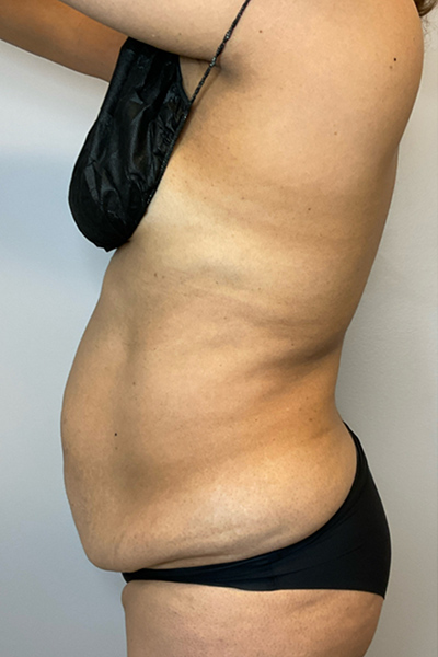 Before Image: Tummy Tuck - left-side