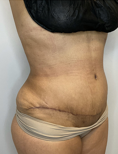 After Image: Tummy Tuck - right-front-oblique