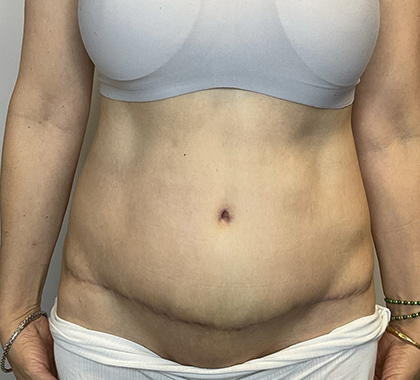 After Image: Tummy Tuck - front
