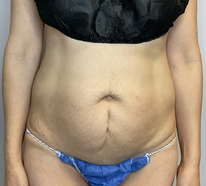 Before Image: Tummy Tuck - front
