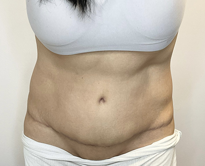 After Image: Tummy Tuck - front