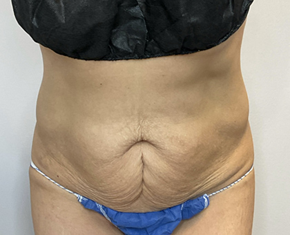 Before Image: Tummy Tuck - front