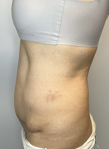 After Image: Tummy Tuck - left-side