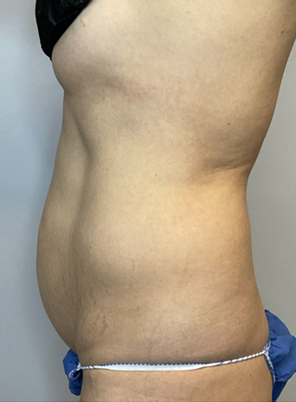 Before Image: Tummy Tuck - left-side