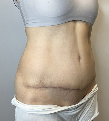 After Image: Tummy Tuck - right-front-oblique
