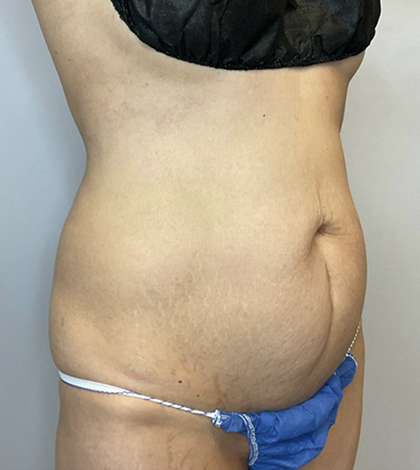Before Image: Tummy Tuck - right-front-oblique