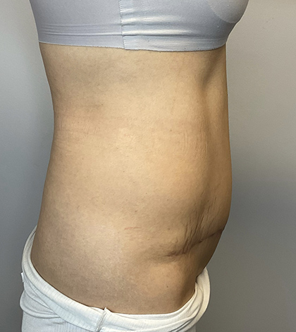 After Image: Tummy Tuck - right-side