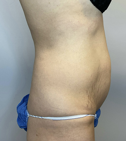 Before Image: Tummy Tuck - right-side