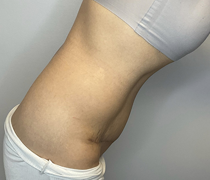 After Image: Tummy Tuck - right-side