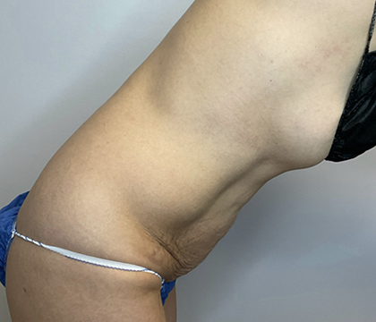 Before Image: Tummy Tuck - right-side